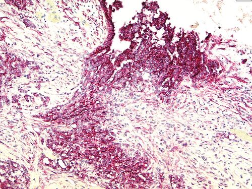 Immunhistochemische Reaktion mit dem D2-40 Antikörper bei einem biphasischen Mesotheliom