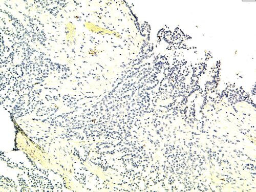 Negativer Reaktionsausfall mit dem TTF1 Antikörper bei einem biphasischen Mesotheliom