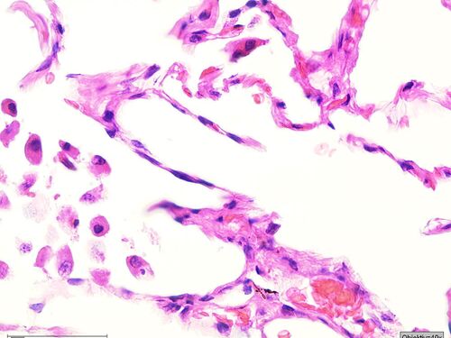 Asbestkörper im histologischen Schnittpräparat, HE-Färbung