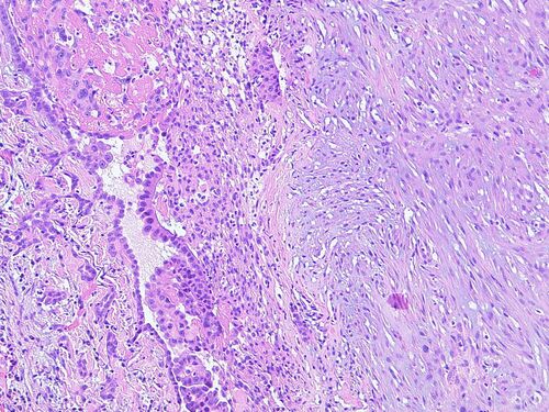 Biphasisches Mesotheliom HEPräparat