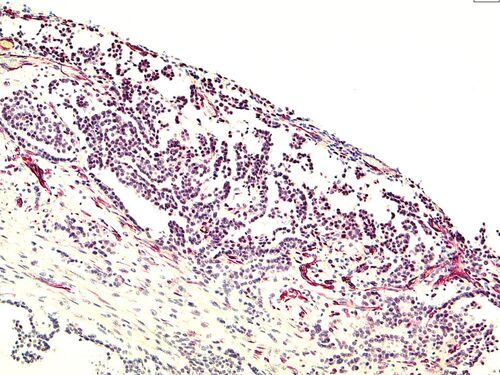 Immunhistochemische Reaktion mit dem WT1 Antikörper bei einem biphasischen Mesotheliom