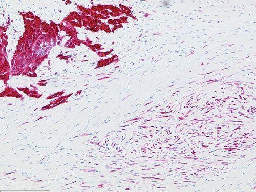 Immunhistochemische Reaktion mit dem Calretinin Antikörper bei einem biphasischen Mesotheliom