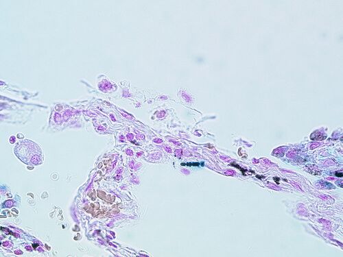 Asbestkörper im histologischen Schnittpräparat, Eisenfärbung